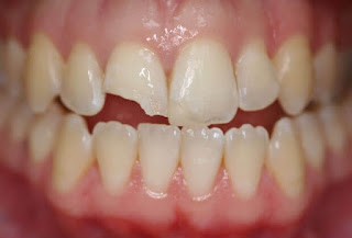 Cách khắc phục tình trạng răng bị mẻ hiệu quả