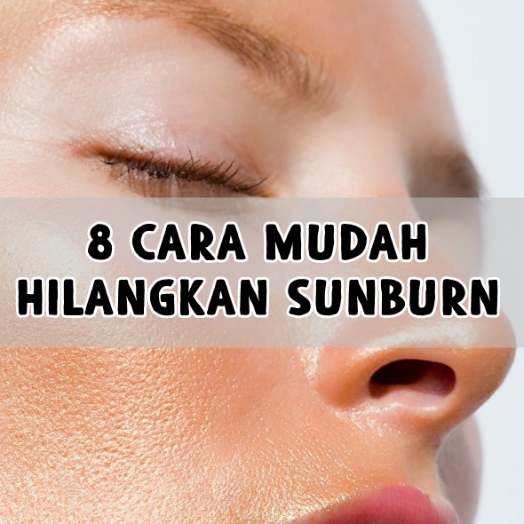 8 Cara Mudah Hilangkan Sunburn 8 Cara Mudah Hilangkan Sunburn