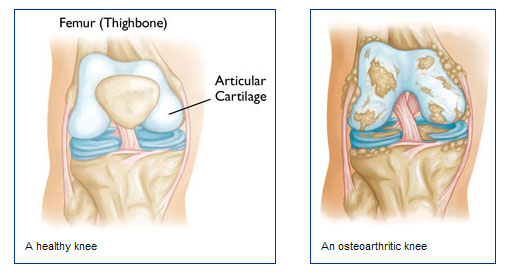artróza a osteoartróza articulații și medicamente de întărire osoasă