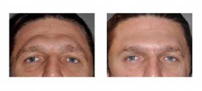Facial Feminization Surgery - Forehead and Jaw Contouring Reshaping