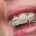 Sự thật niềng răng không nhổ răng có được không?