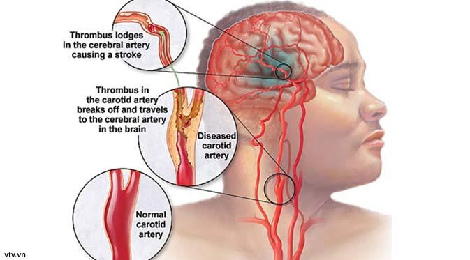 Image result for Migrain, atau penyempitan pembuluh di darah otak