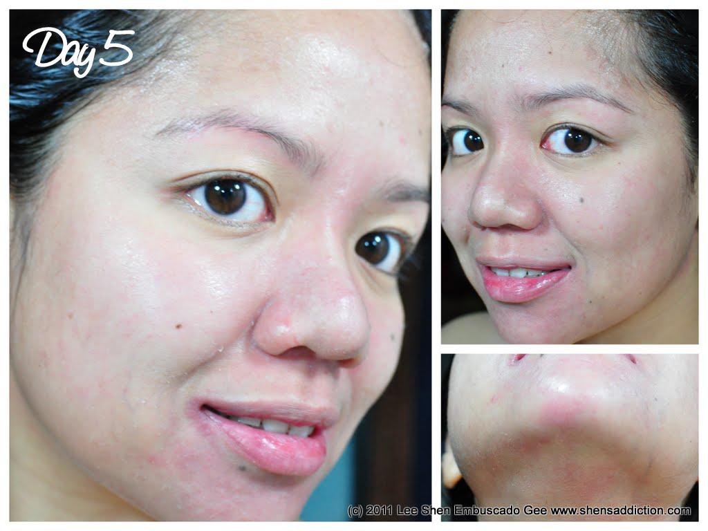 TRUPeel Procedure at House of Obagi Day 5 and 6 Shen's Addiction TRUPeel Procedure at House of Obagi Day 5 and 6 Shen's Addiction