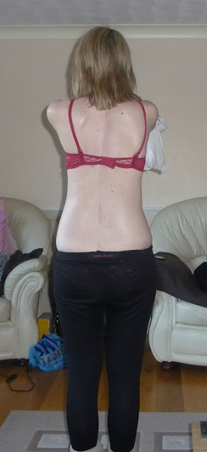 My scoliosis scar one year post op