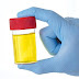 How to use Urine to Check your HIV/AIDS status
