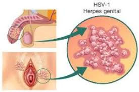 Foto Obat Paling Ampuh Untuk Penyakit Herpes Simplex
