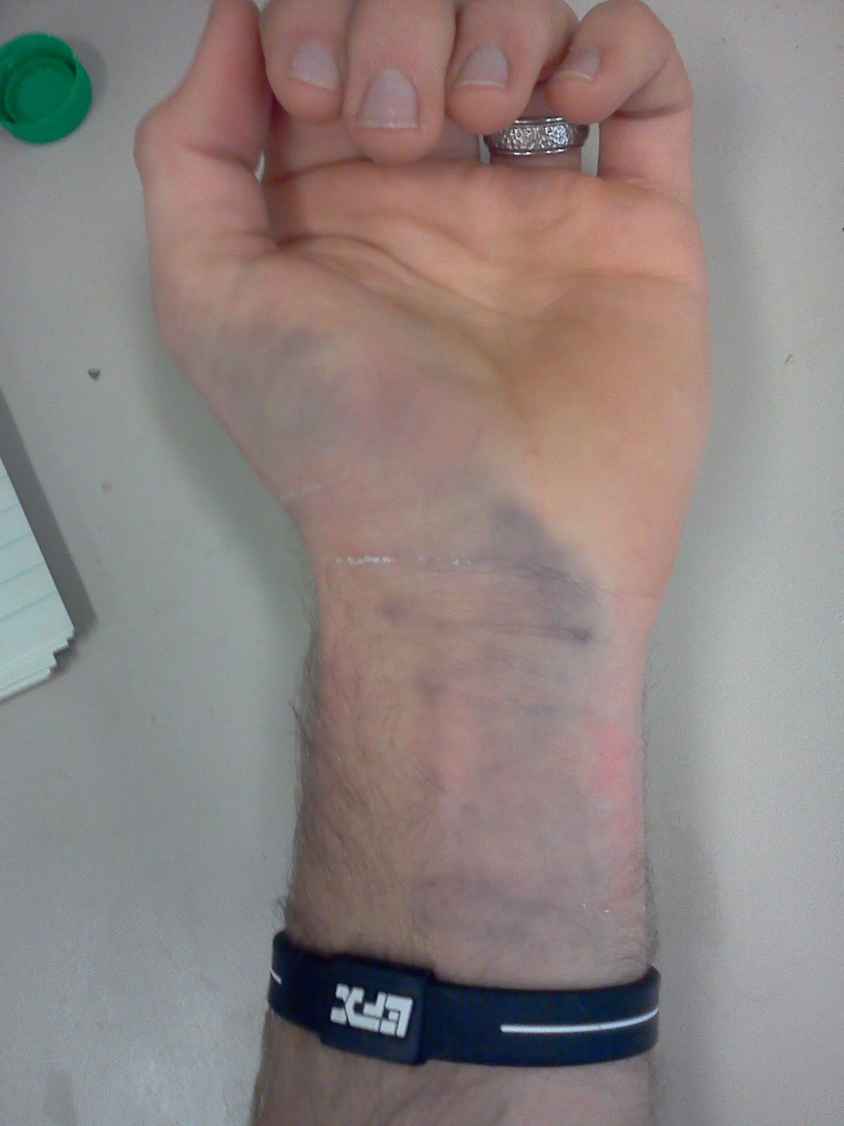 Clint Claassen Injury Update Wrists and Rhinos