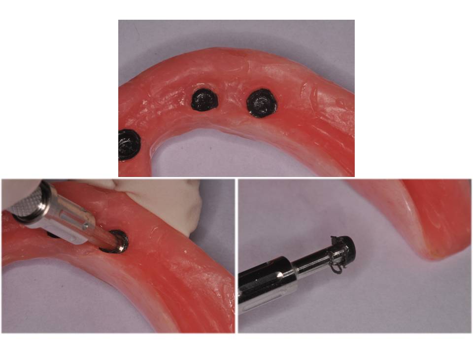 Dental Clinical Case Presentations StepbyStep guides Changing Locator Attachments (Locator