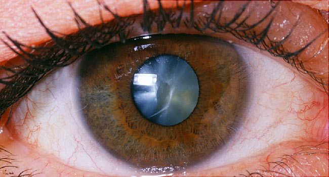WHAT IS A CATARACT?