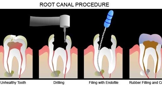 Why do I still have pain from a partial root canal? - Quora