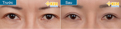 Tổng hợp những cách trị bọng mỡ mắt cứng đầu (3)