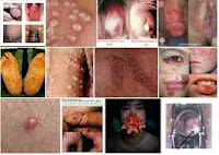 Apa Obat Di Apotik Yang Mampu Menyembuhkan Sipilis Apa Obat Di Apotik Yang Mampu Menyembuhkan Sipilis