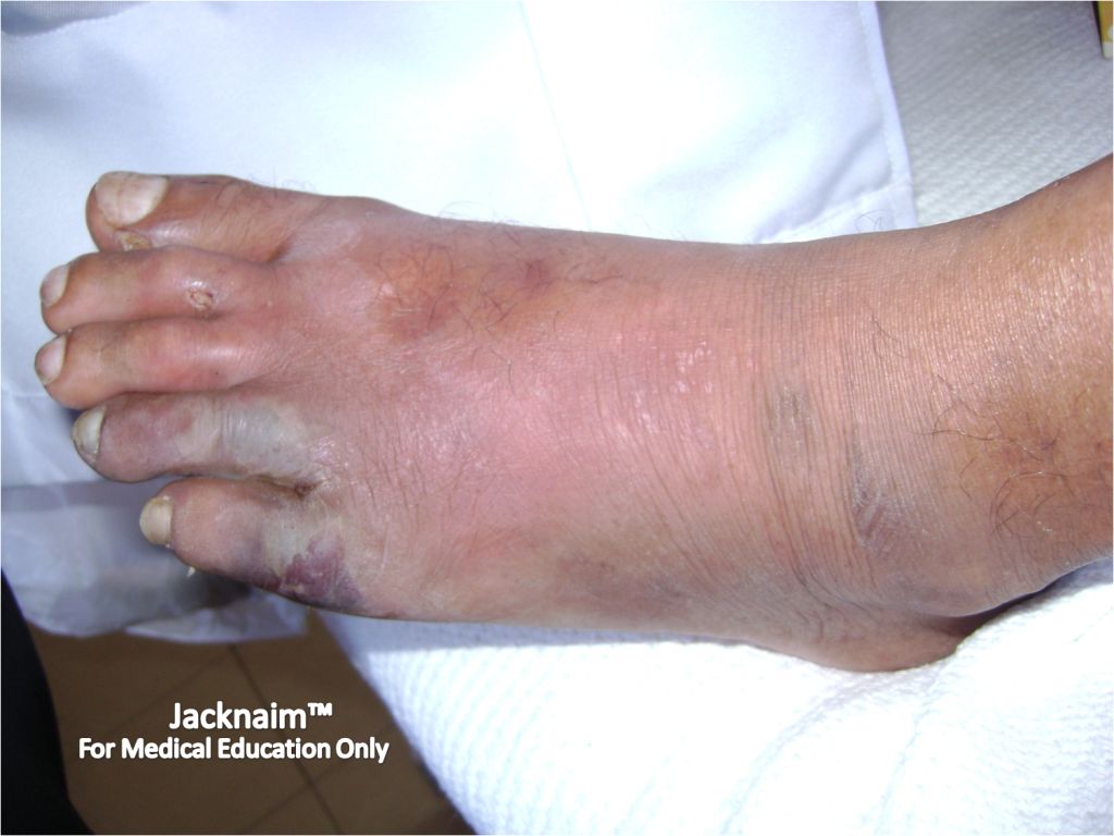 Diabetic Foot Ulcer Pictures 1 Symptoms And Pictures vrogue.co