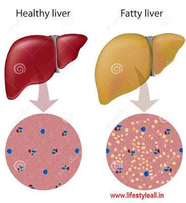 Fatty Liver : Types, Causes and Risk Factors.