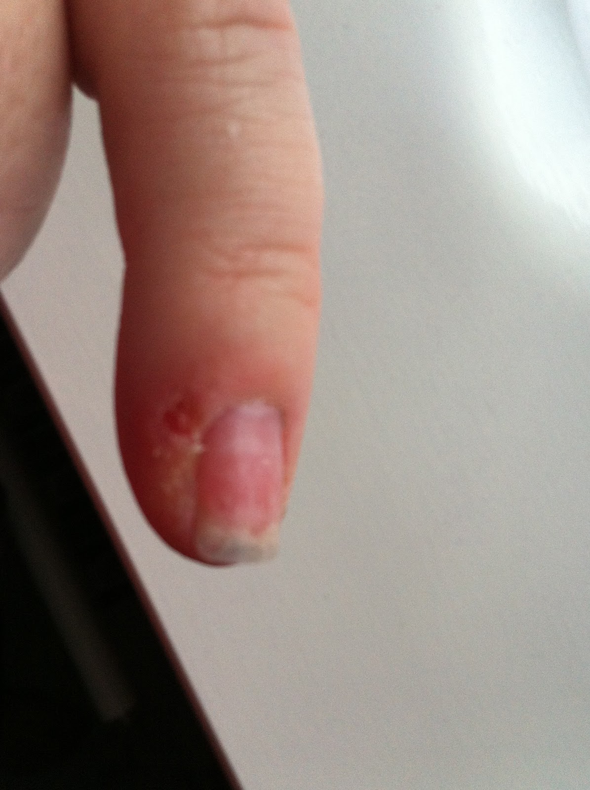 Buying accutane