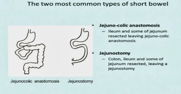 My Gastro Room: Intestinal resection and short bowel syndrome