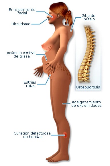 joroba de búfalo sintomas de diabetes