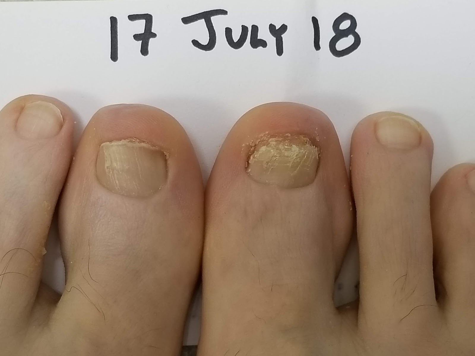 Run with Perseverance A Tale of Two Toenails; How to Fix Runner's Toenails