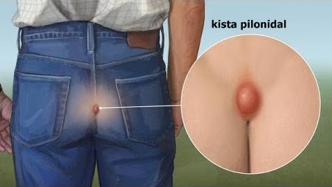 Cara Menghilangkan Benjolan Di Tulang Ekor Dengan Cepat Cara Menghilangkan Benjolan Di Tulang Ekor Dengan Cepat