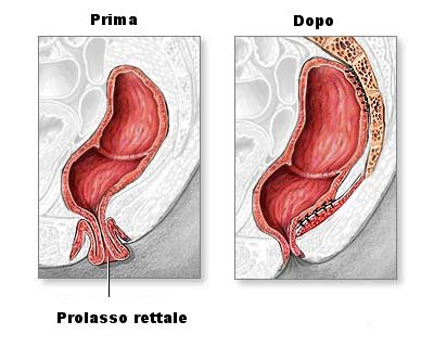 Prolasso rettale