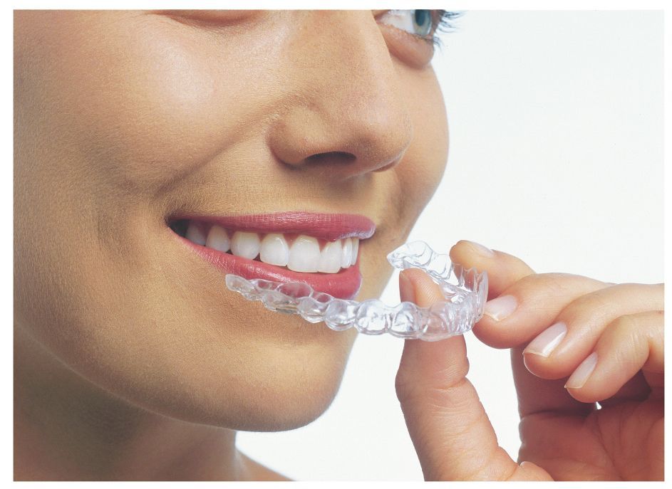 Teen Aligners Are Made 58