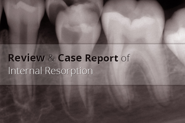root resorption