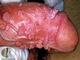 obat tradisional kutil kelamin obat tradisional kutil kelamin