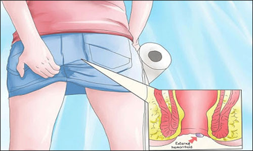 menghilangkan ambeien dengan cepat, penanganan ambeien luar, foto ambeien luar, obat ambeien paling bagus,
