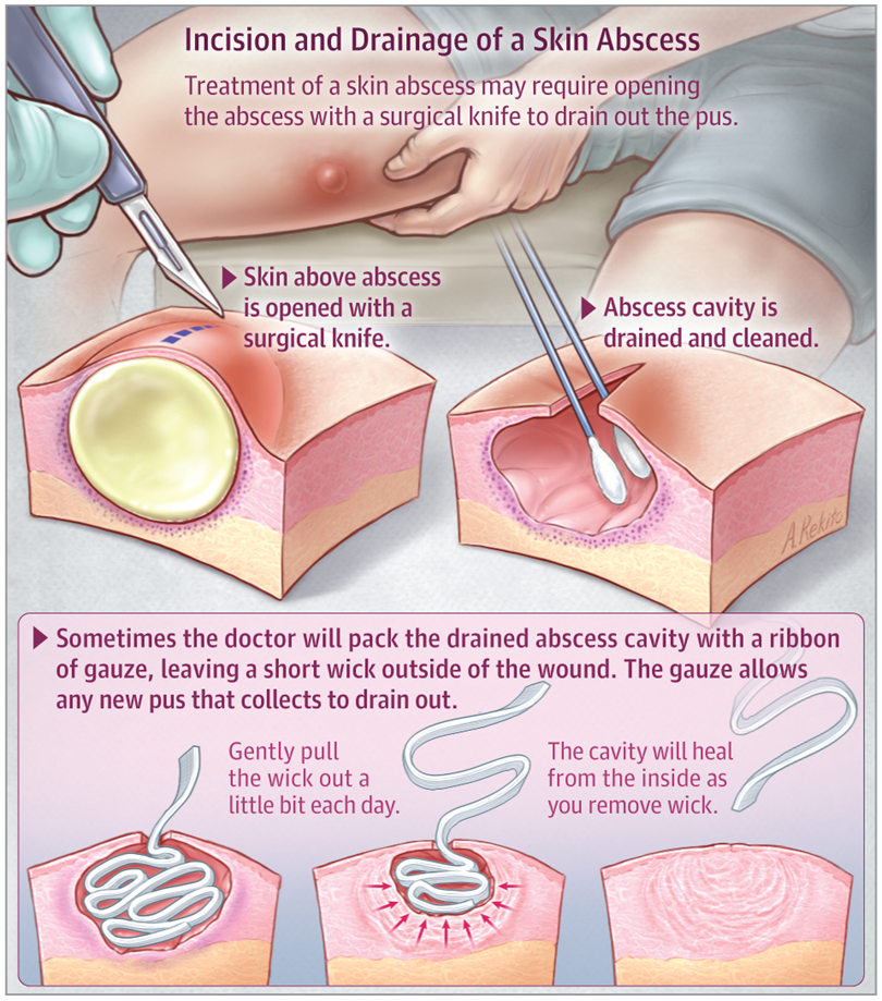 anal heal Open time abscess anal heal Open time abscess