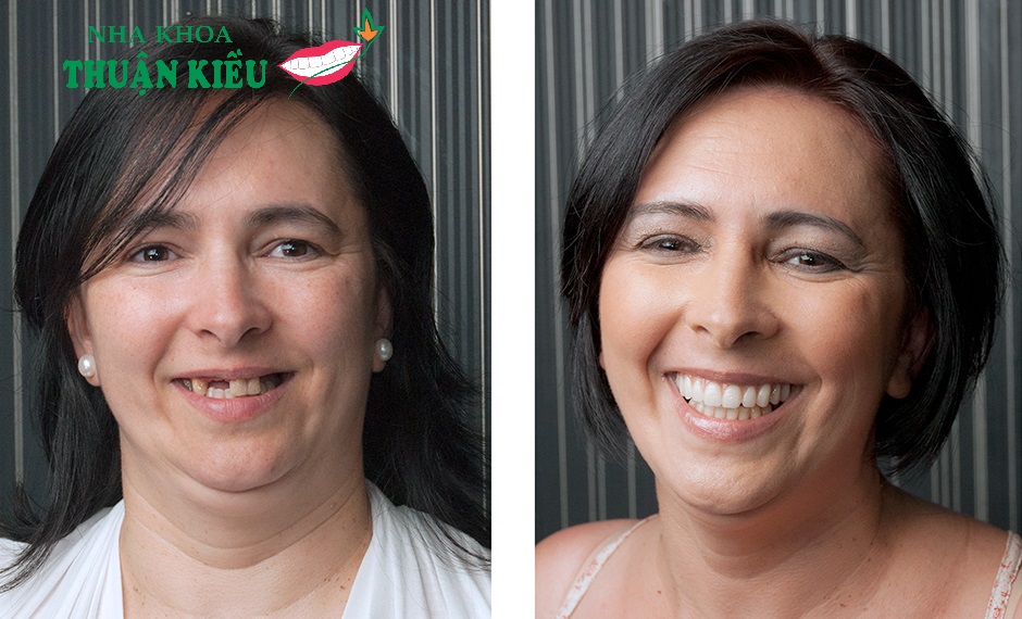 Finding Better Dental Implant Prices in Vietnam Dental Implants in