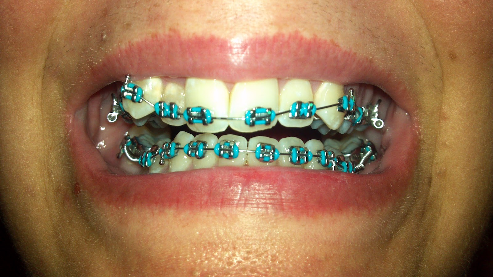 How To Eat With Braces And Expander Say Braces! Plate Expander of