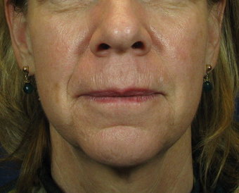 jowls droopiness flabby furrows jawline vir eliminate