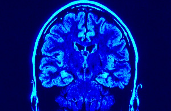 Alzheimer y estimulación cognitiva