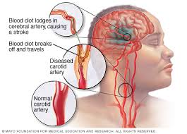 Cari Obat Alami Mengatasi Stroke Masih Ringan, apa nama obat ampuh stroke berat?, Bagaimana Mengobati Penyakit Stroke Ringan?