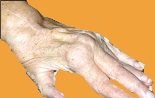 Rheumatoid Arthritis (RA) Causes and Symptoms