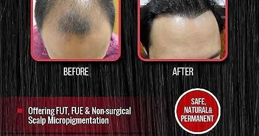 Manila Shopper: Hair Loss is Inevitable, But There's a Permanent Solution -  MAXim Hair Restoration