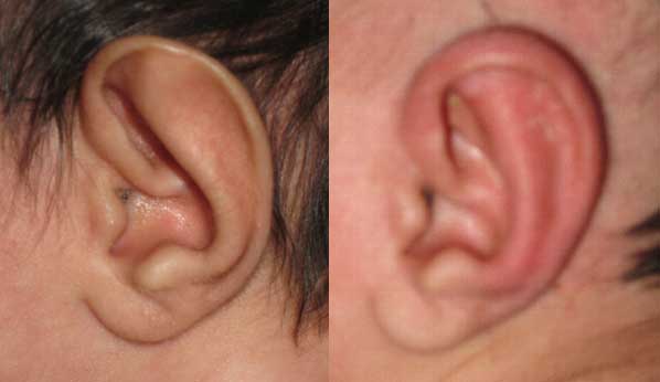 results of earwell splinting for baby ear deformities