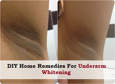 DIY Home Remedies For UnderArm Whitening DIY Home Remedies For UnderArm Whitening