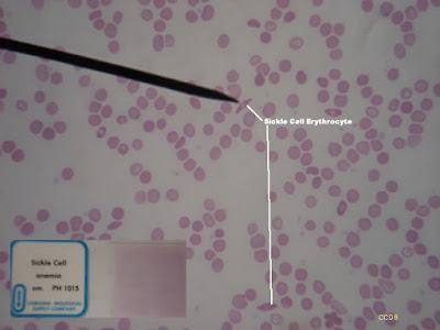 Human Sickle Cell Anemia