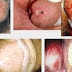 Apa Nama Obat Dokter Untuk Sipilis