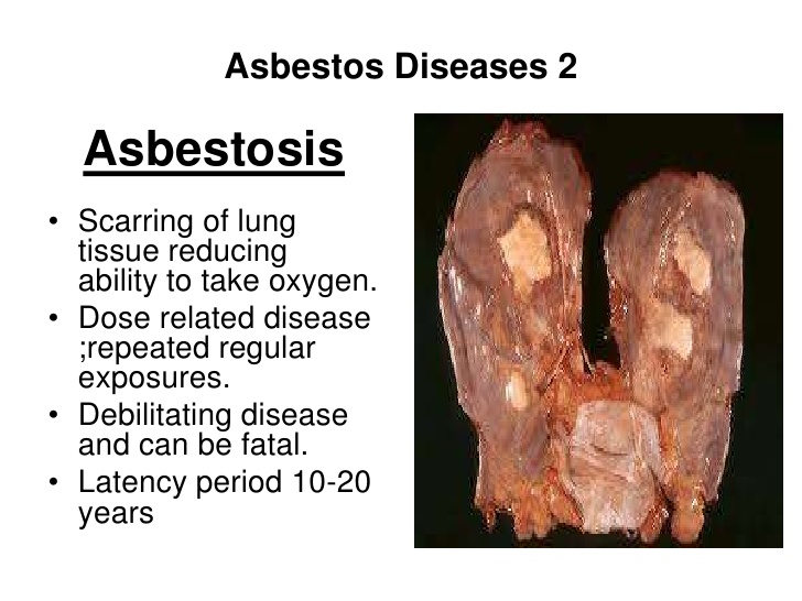 asbestosdisease