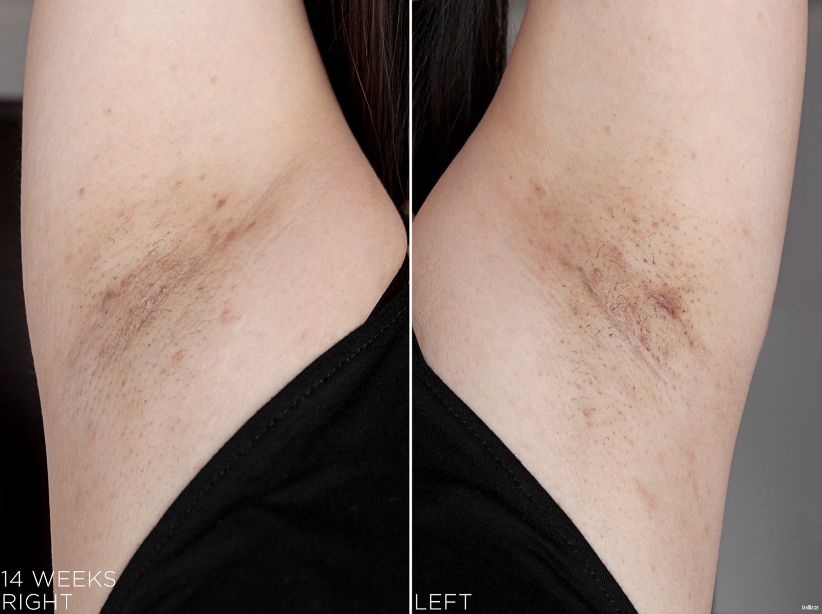 tria Hair Removal Laser Armpits Hair 14 Weeks, 3 months