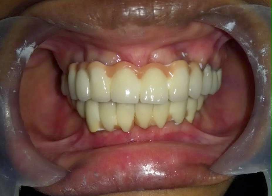 Dental Implants From Canada Experienced and Expert Dental