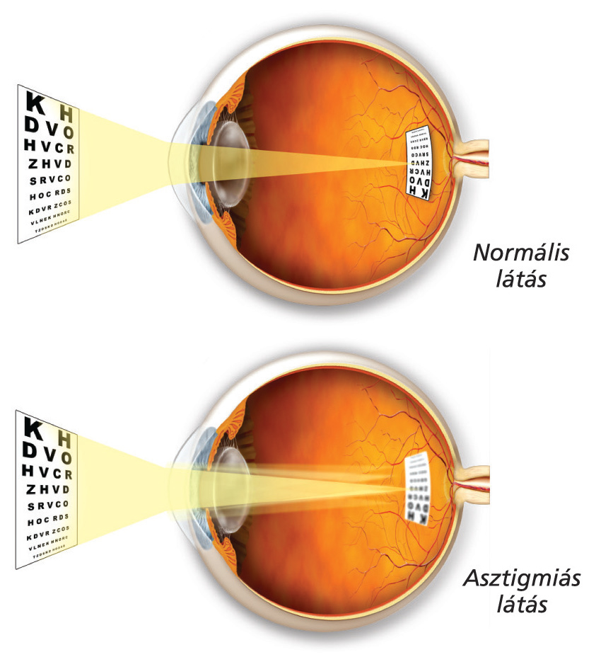 Atropinos szemcsepp a rövidlátás megelőzésére