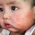 Obat Eksim Kering Tradisional Untuk Anak
