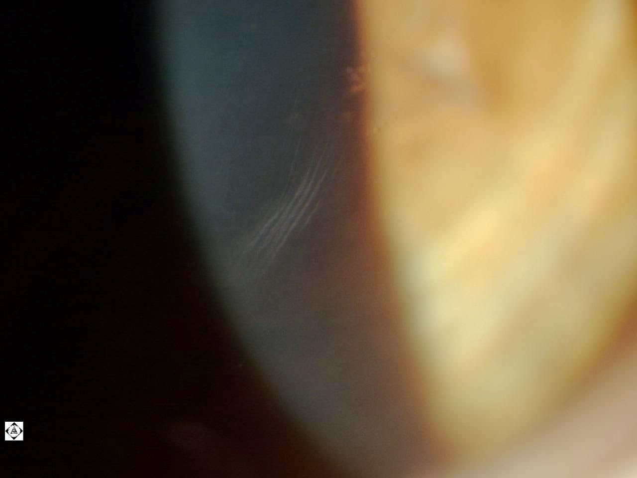 VOGT'S STRIA IN KERATOCONUS Sonoran Desert Eye Center