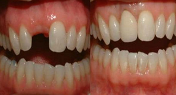 Baru-Baru ini Ditemukan Cara untuk Tumbuhkan Gigi yang Ompong hanya dalam Waktu 9 Minggu.