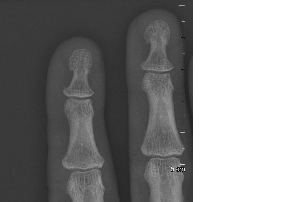 Rheumatologe Chest Xray and nail clubbing