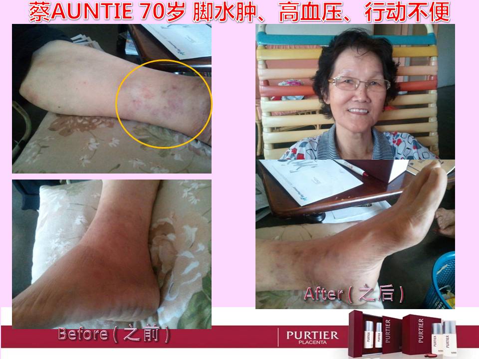 Aunty Chai (70 years old) - Water Retention To Leg, High Blood Pressure, Unable To Walk Properly