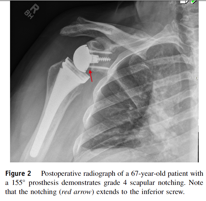 Shoulder Arthritis / Rotator Cuff Tears / Shoulder Pain Does humeral